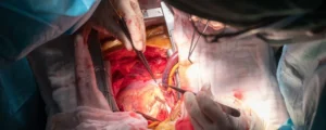 Coronary Artery Bypass Grafting (CABG)