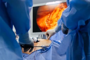 Laparoscopic Surgery for PCOS