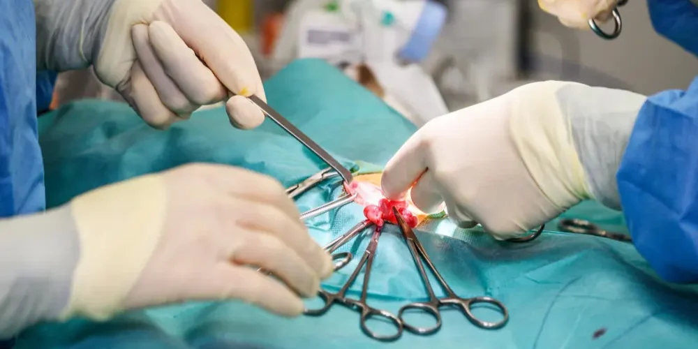 Laparoscopic Surgery for PCOS
