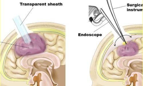 Neurology in Thane